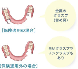 部分入れ歯：保険適用と適用外の場合