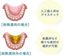 総入れ歯：保険適用と適用外の場合