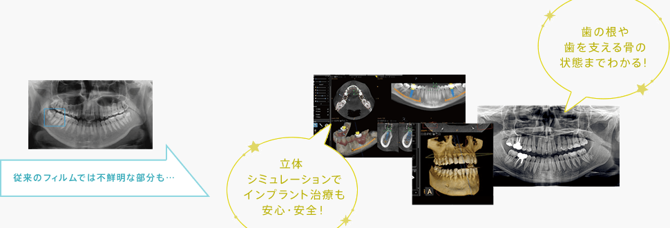 立体シミュレーションでインプラント治療も安心・安全　歯の根や歯を支える骨の状態までわかる