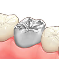 メタルクラウン（保険適用）