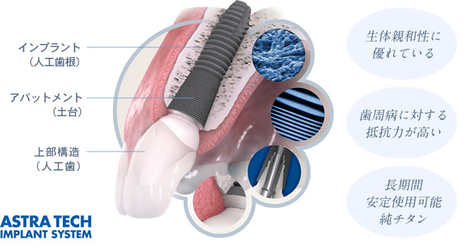 アストラテックインプラントの特徴