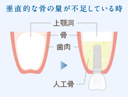 垂直的な骨の量が不足している時