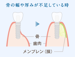 骨の幅や厚みが不足している時