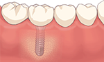 インプラントイメージ