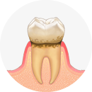 歯垢がたまります