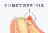 クラウンレングスニング(外科的歯冠長延長術)